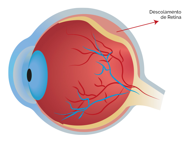 O que é o descolamento de retina?